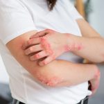 Nourish Your Skin: 5 Foods to Combat Eczema Flare-Ups