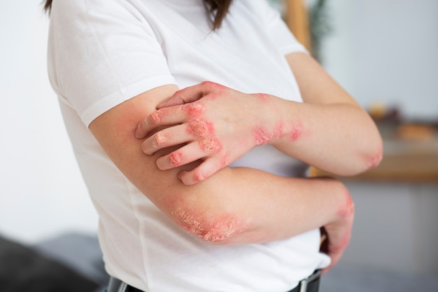 Nourish Your Skin: 5 Foods to Combat Eczema Flare-Ups