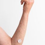 Nourishing Your Skin: 5 Foods to Alleviate Eczema Symptoms