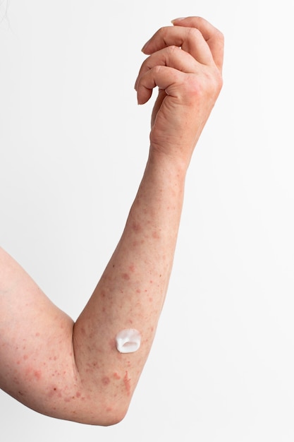 Nourishing Your Skin: 5 Foods to Alleviate Eczema Symptoms